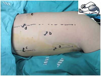 Double-Docking Technique, an Optimized Process for Intrathoracic Esophagogastrostomy in Robot-Assisted Ivor Lewis Esophagectomy